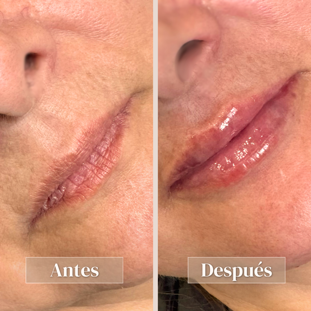 Aumento de labios - Vista 1