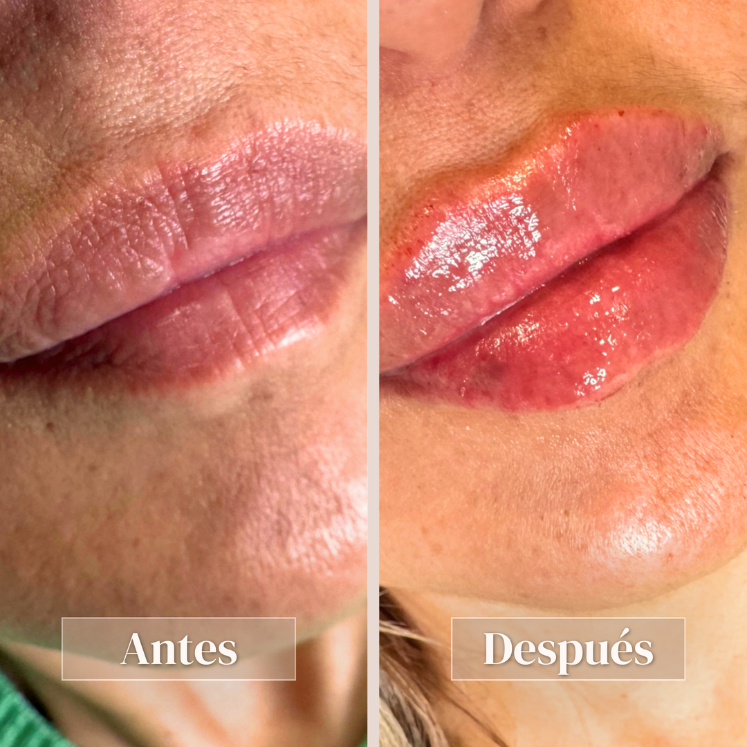 Aumento de labios - Vista 2