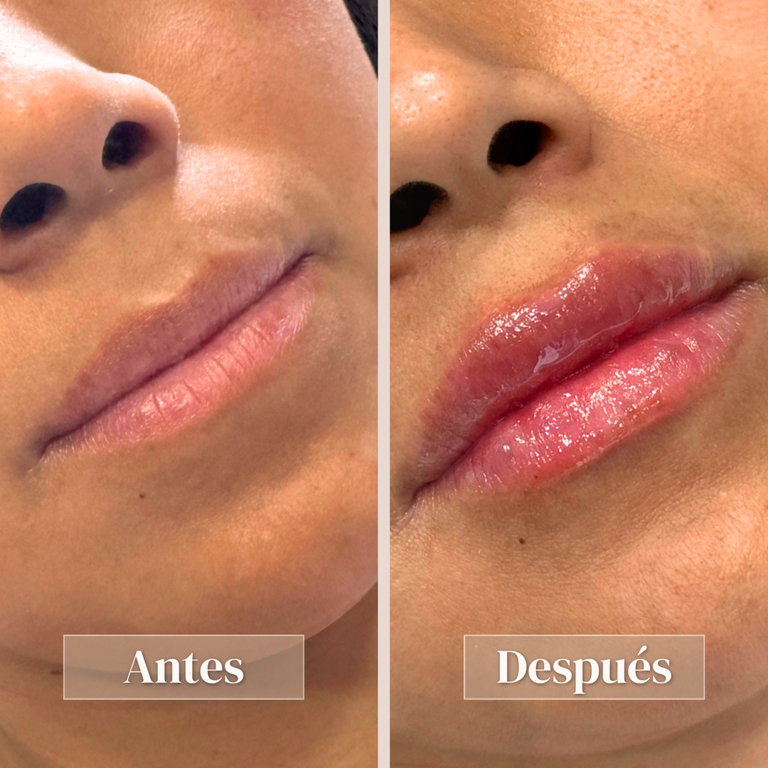Aumento de labios - Vista 3